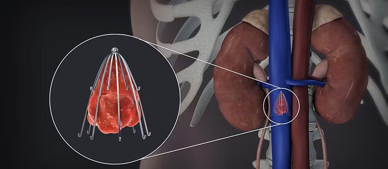 IVC Umbrella Placement